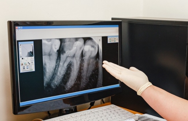 Dentist gesturing to computer screen showing digital x rays of teeth