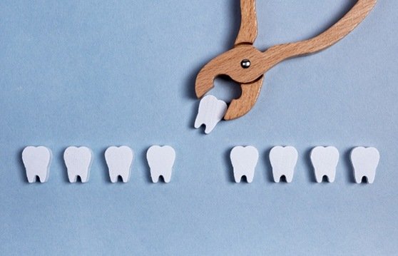 Illustrated clasp grabbing a tooth from a row of teeth
