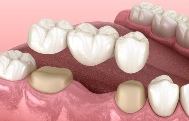 Illustrated dental bridge replacing a missing tooth