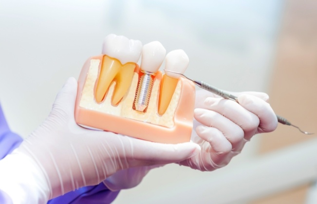 Dentist gesturing to a model of a dental implant