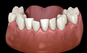 Patient in Federal Way with crowded teeth