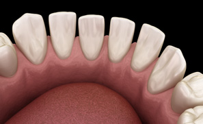 Patient in Federal Way with tooth gaps