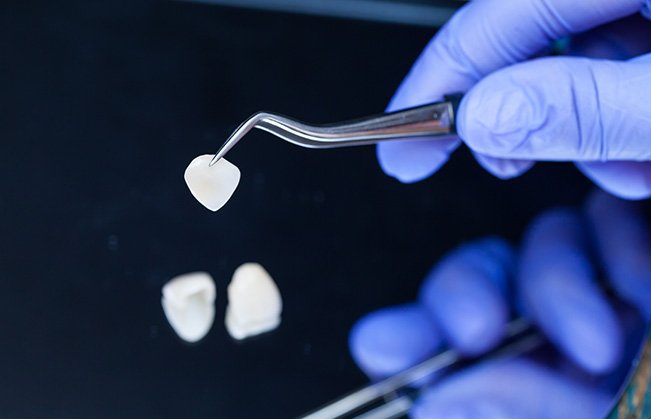 A dentist holding a veneer with tweezers