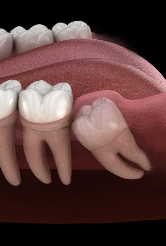 Illustration of impacted wisdom tooth pressing against adjacent tooth