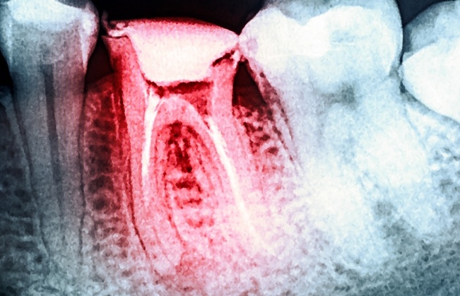 Dental x ray with impacted wisdom tooth highlighted red