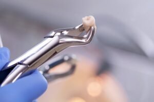 Forceps holding extracted tooth. 