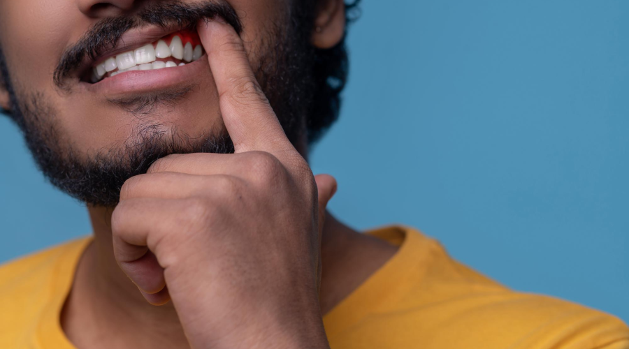 White Spots on Gums