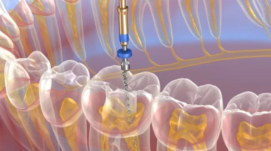 Same-Day Emergency Root Canal Treatment in Federal Way