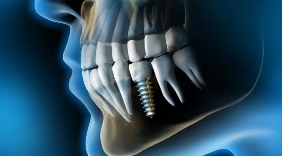 Can Dental Implants Fail? Federal Way Patient Guide
